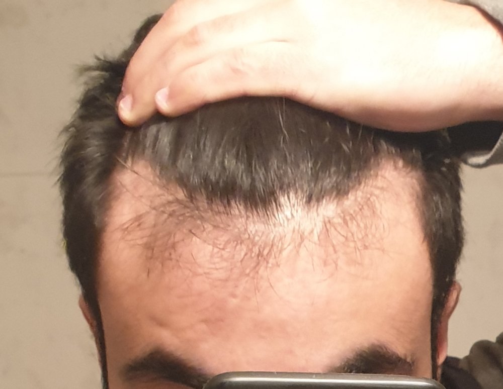 Receding Hairline Male Pattern Baldness Or Maturing
