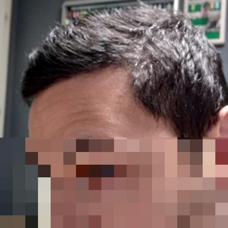 05-mesi-hair loss-1.jpg