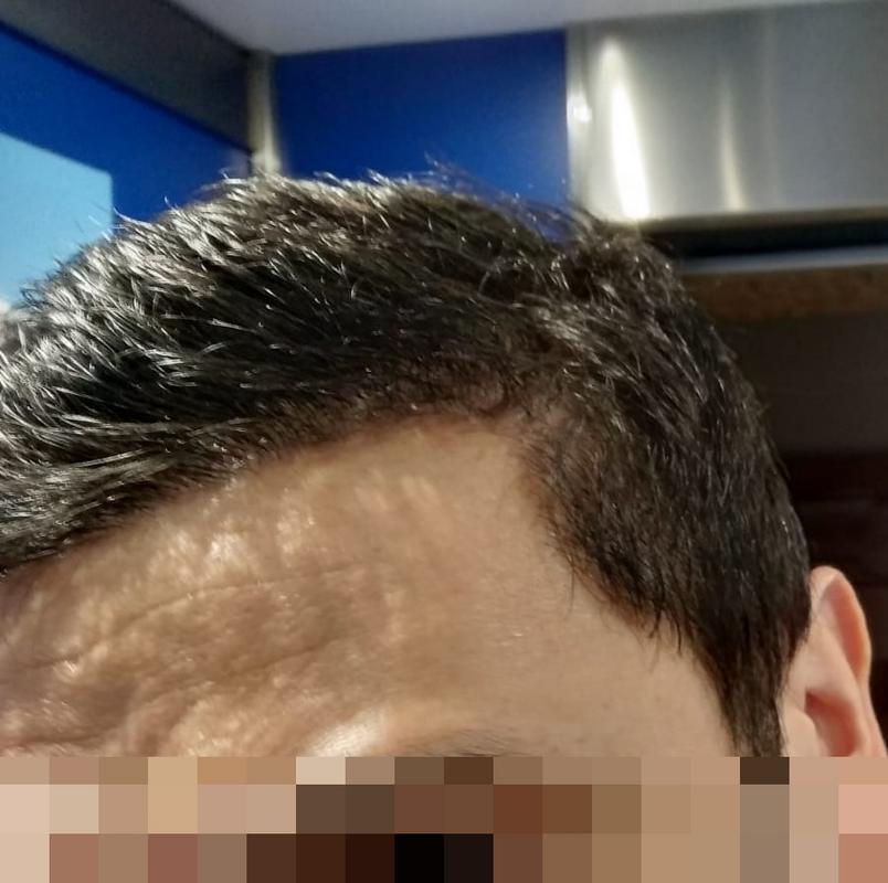 05-mesi-hair loss-2.jpg