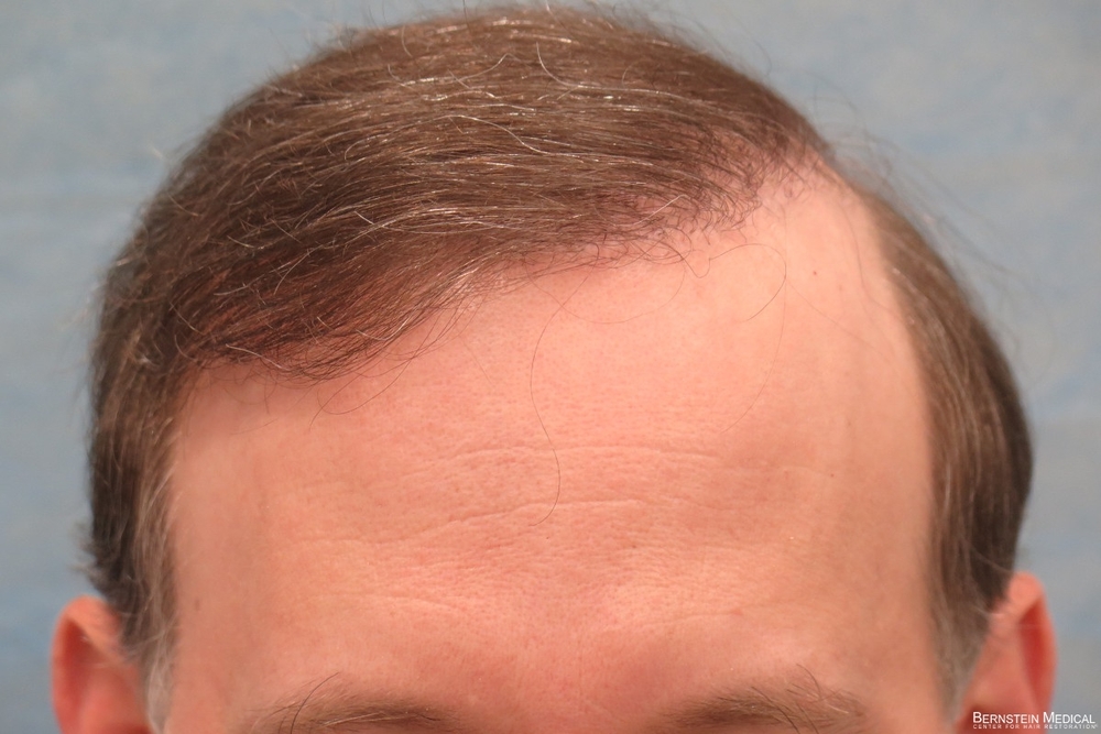 0b_after-hair-transplant-repair_eti.jpg