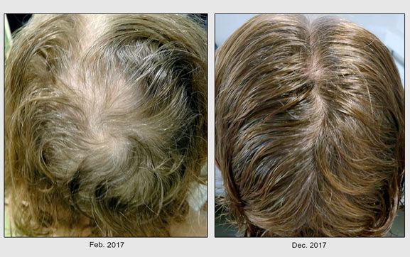 Loss And Regrowth. Progress Pictures. Treatment Timeline And Details.  Shedding. Health Effects. | HairLossTalk Forums