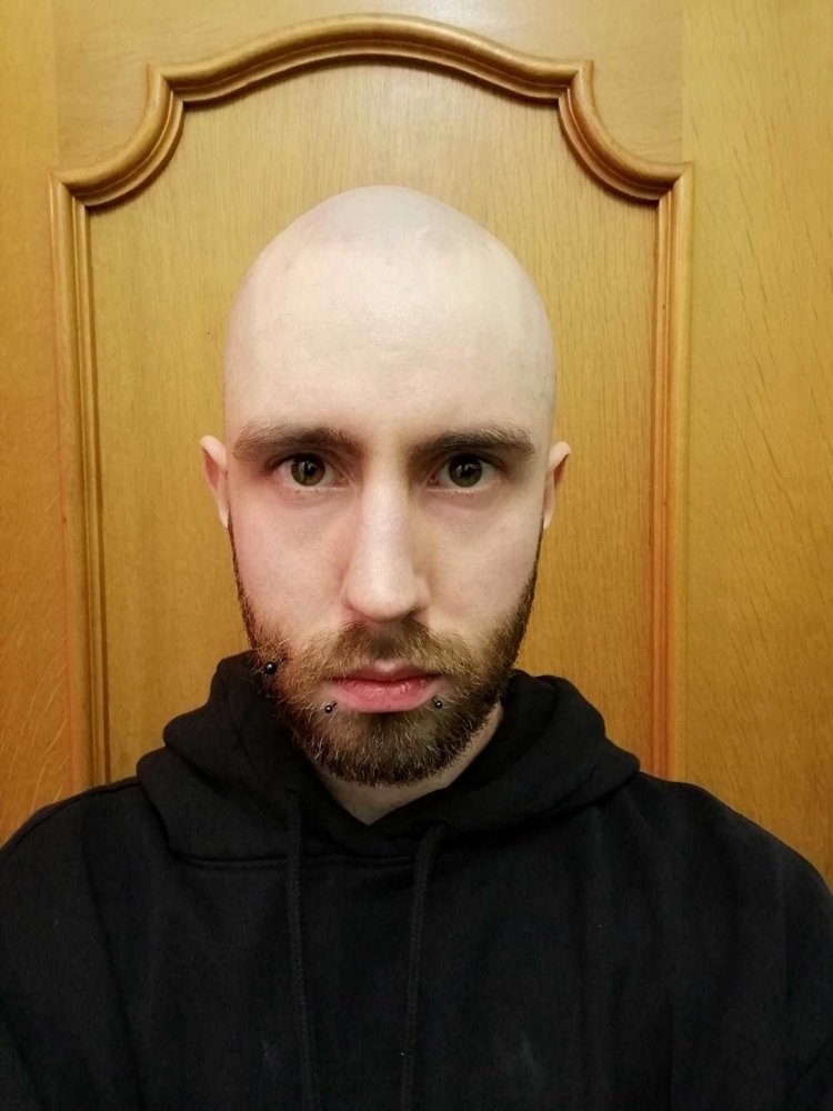 Going bald weird shaped head Losing hair
