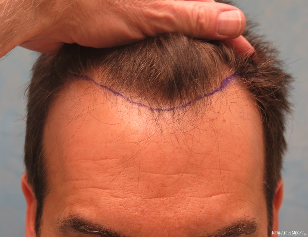 1b-position-of-planned-hairline-esr.jpg