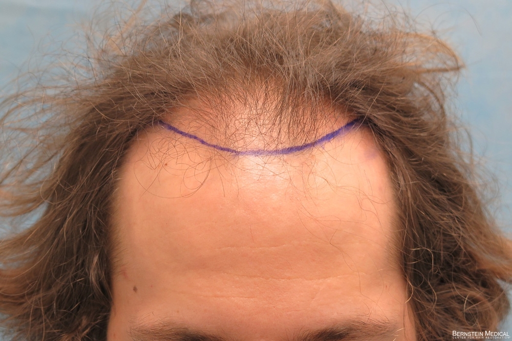 1b_planned-hairline_rsi.jpg