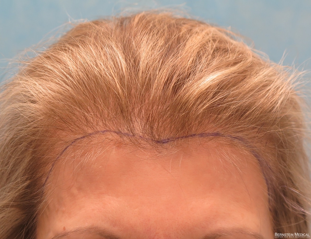 1b_position-of-hairline_gbe.jpg