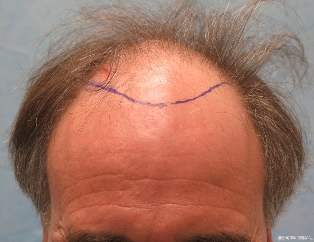 1b_position-of-hairline_ioi.jpg