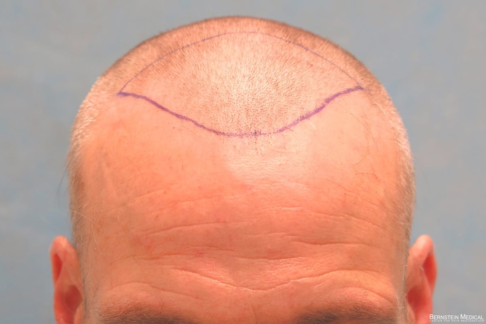 1b_position-of-hairline_lki.jpg