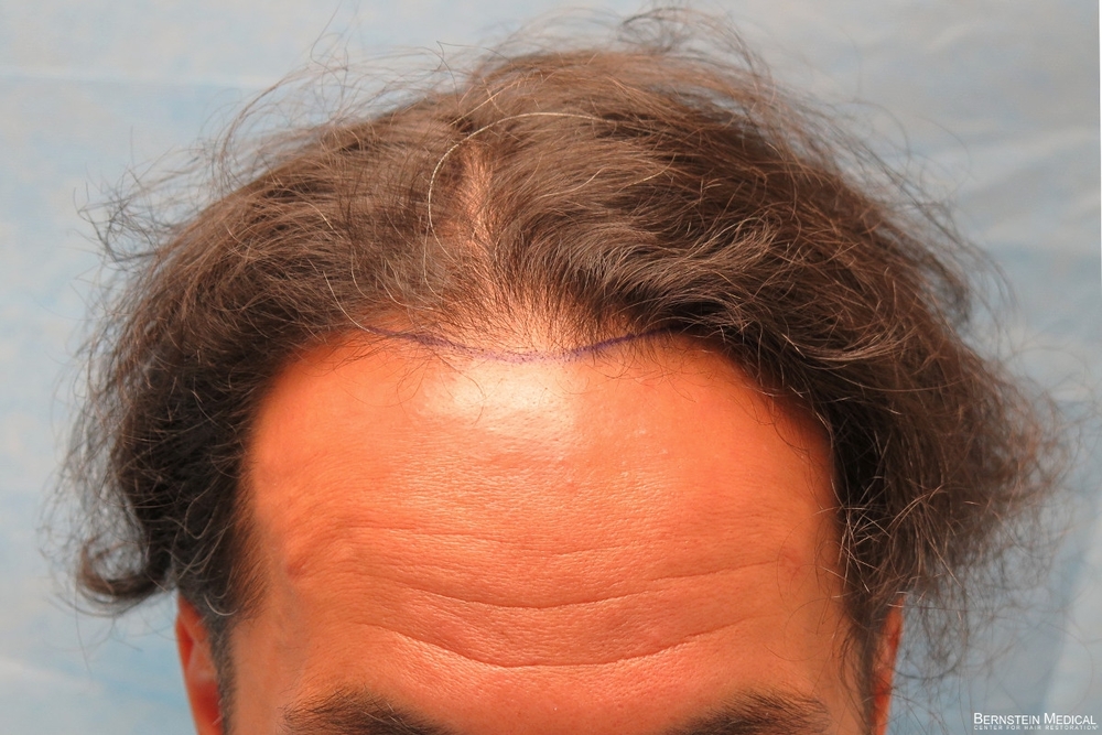 1b_position-of-hairline_znq.jpg