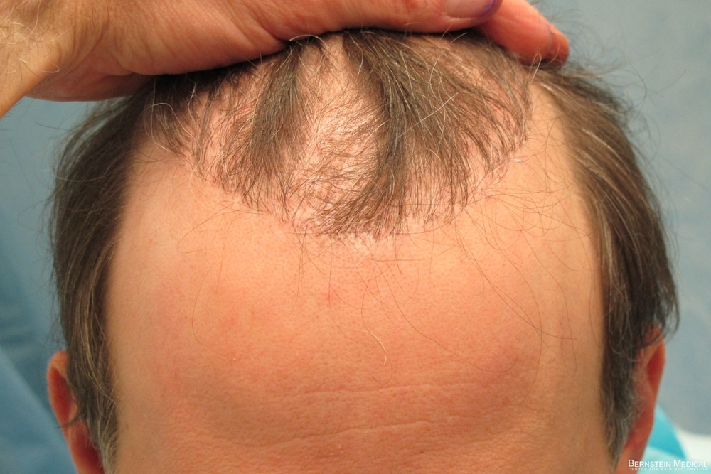 1b_unnatural-hairline-before-repair_eti.jpg