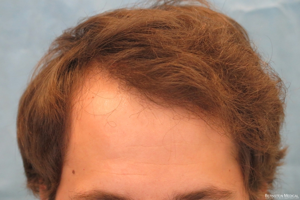 1f_1-year-after-hair-transplant_rsi.jpg