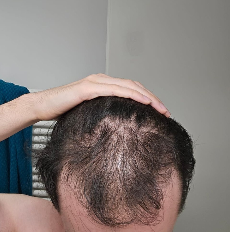 2 months off finasteride.jpg