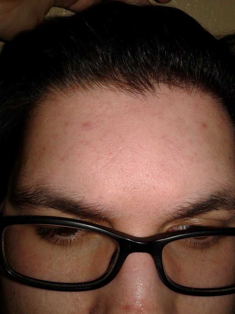 Why Does My Hairline Look Like This? HairLossTalk Forums