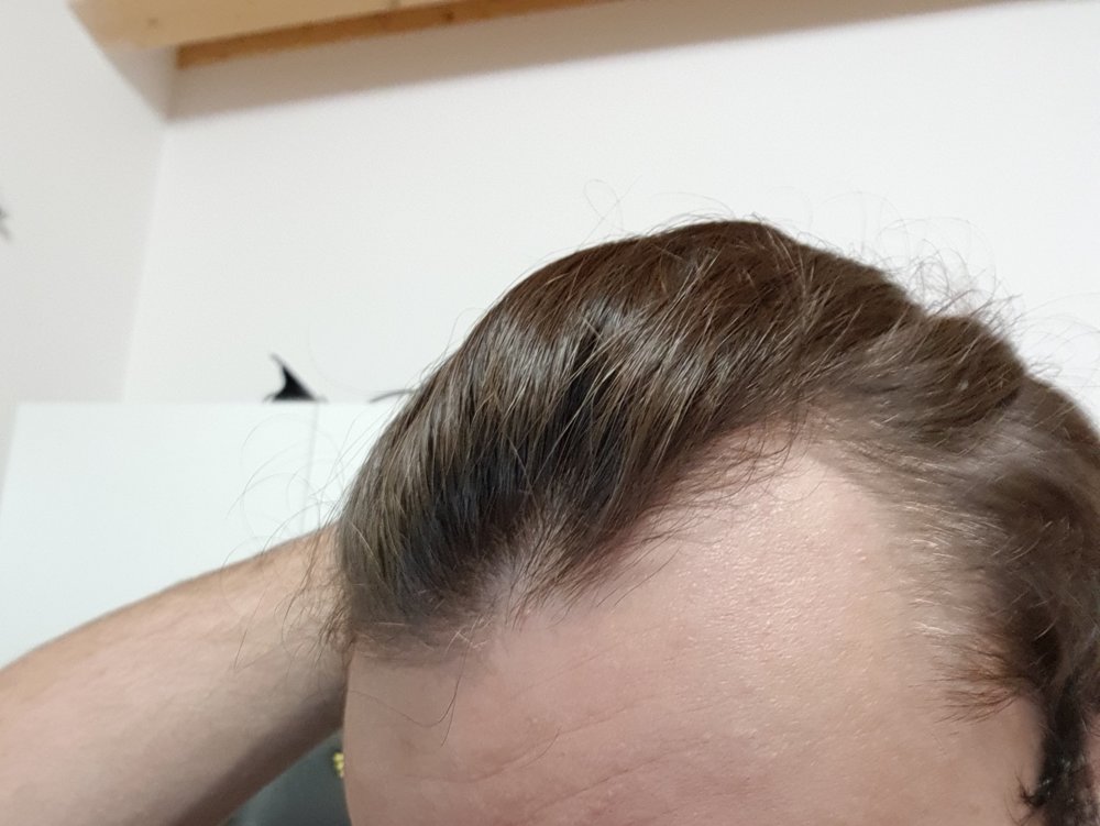 Receding Hairline At 19 Years Old (?) HairLossTalk Forums