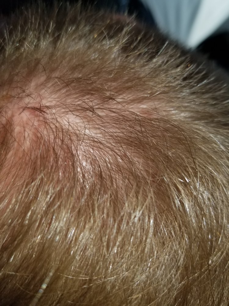 Is My Hair Loss, Scalp Bumps, Oily Skin, Chest/back Acne, Etc. Related? |  HairLossTalk Forums