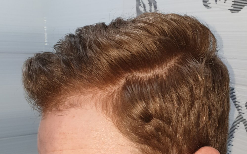 can you stop finasteride for a week