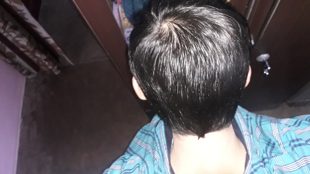 Is it cowlick or am I losing hair? | HairLossTalk Forums