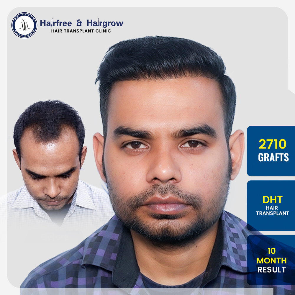2710-grafts-dht-hair-transplant-10-month-result-pune.jpg.jpg