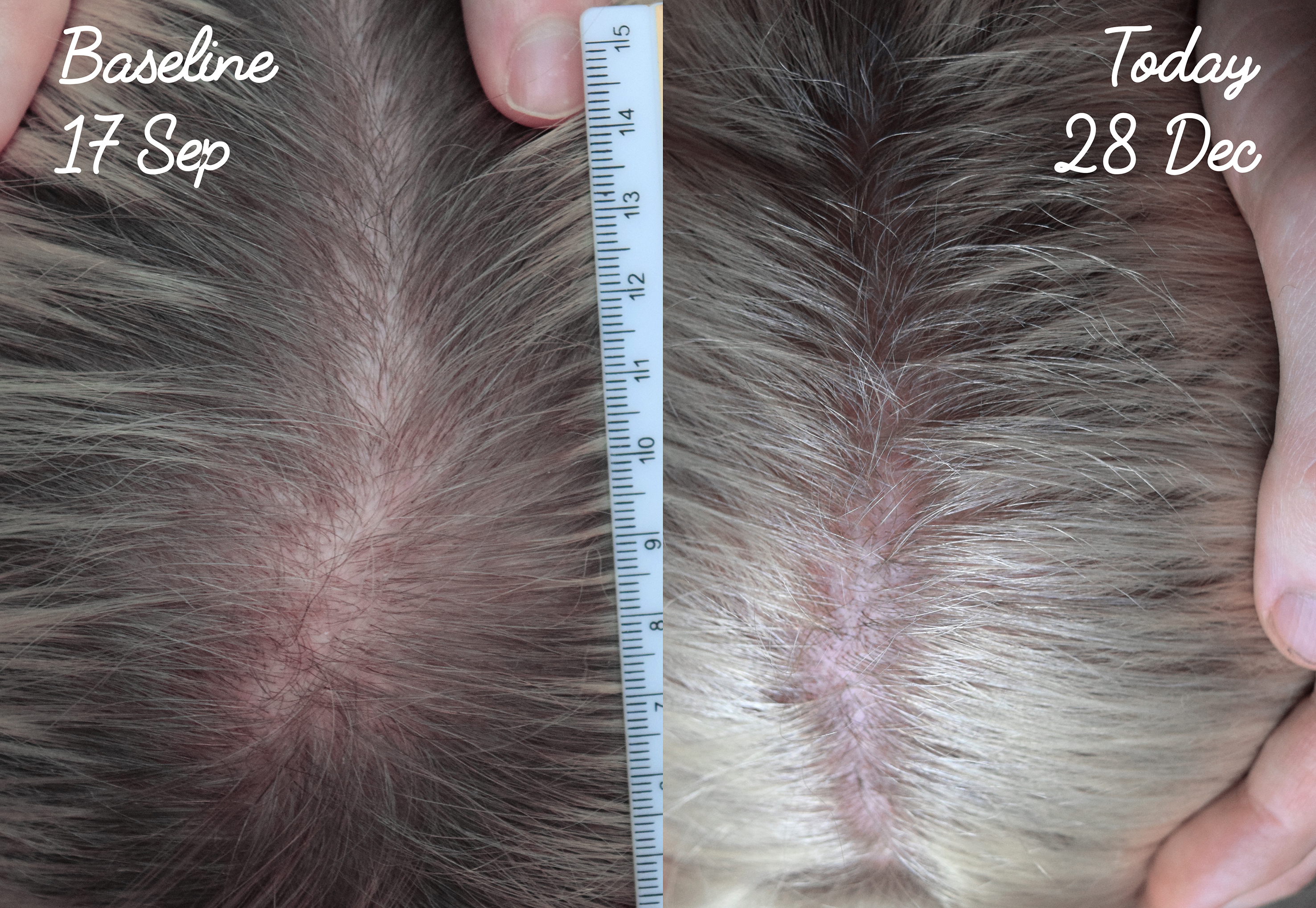 Why are there so many threads of experiencing regrowth with finasteride? |  HairLossTalk Forums