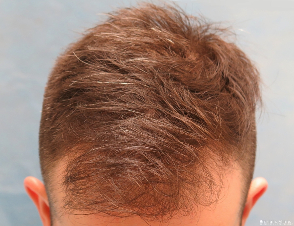 2a_before-hair-transplant-top-view_cfq.jpg