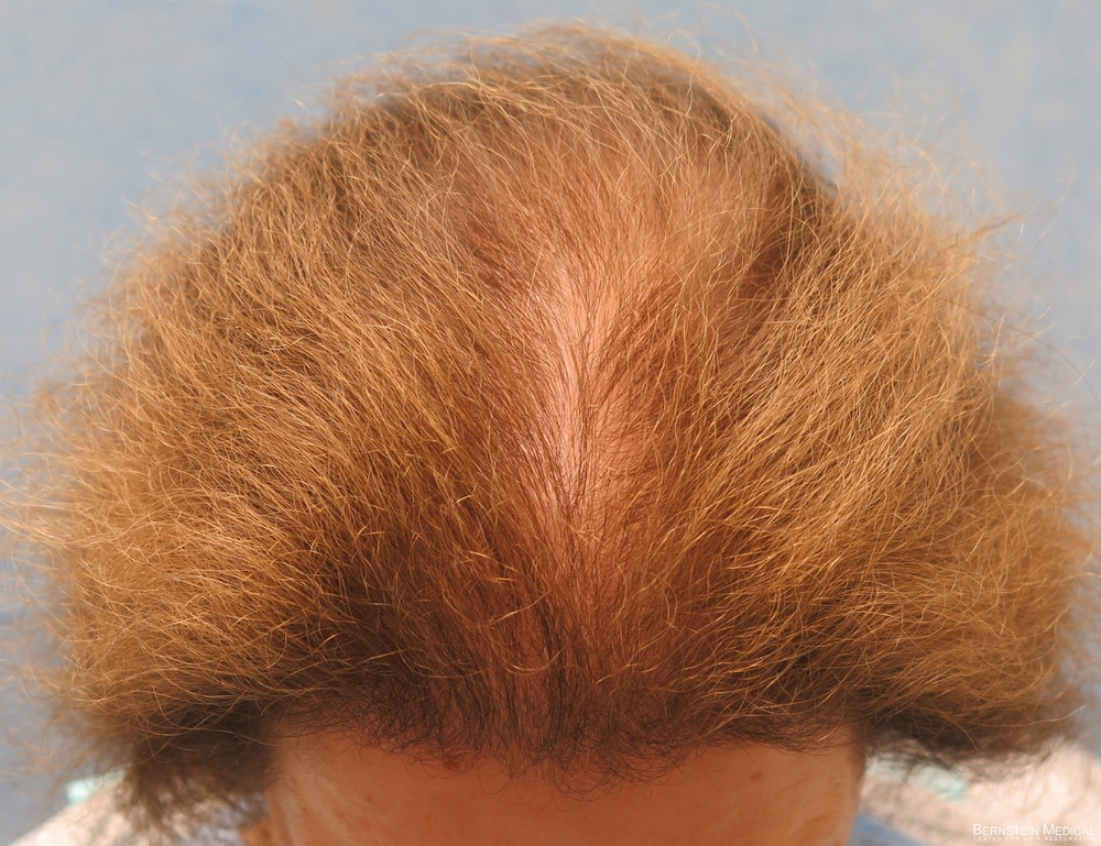 2a_before-hair-transplant-top-view_fpk.jpg