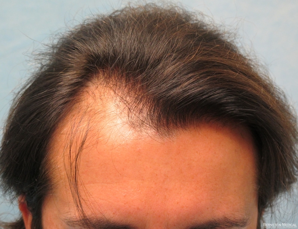 2a_before-hair-transplant_top_odq.jpg