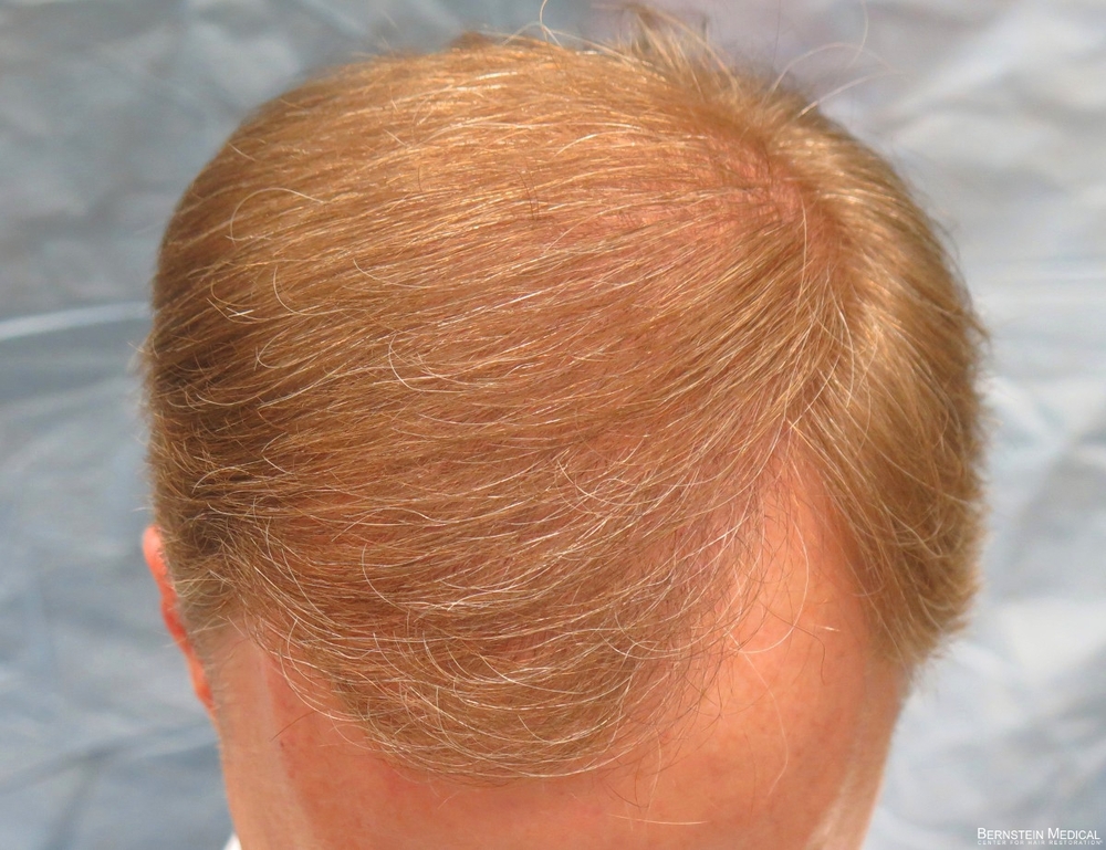 2d_after-hair-transplant-top-view_rfr.jpg