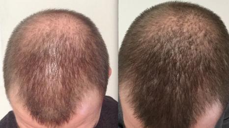 nizoral hair loss forum