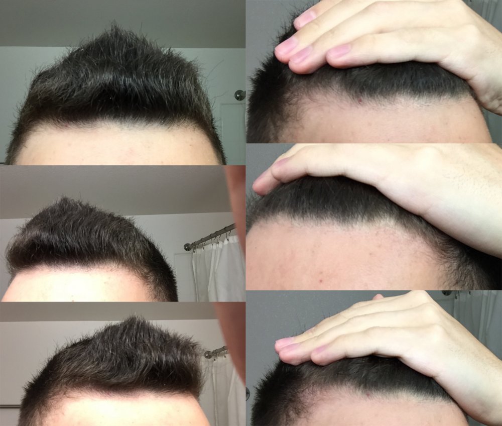 Am I Losing My Hair/should I Be Worried? | HairLossTalk Forums