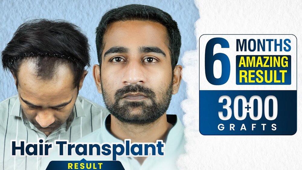 3200 Grafts Hair Transplant in Pune.jpg