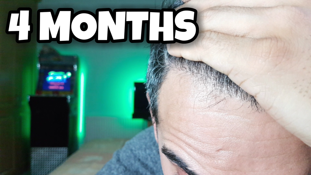 4 Months Hairline.png