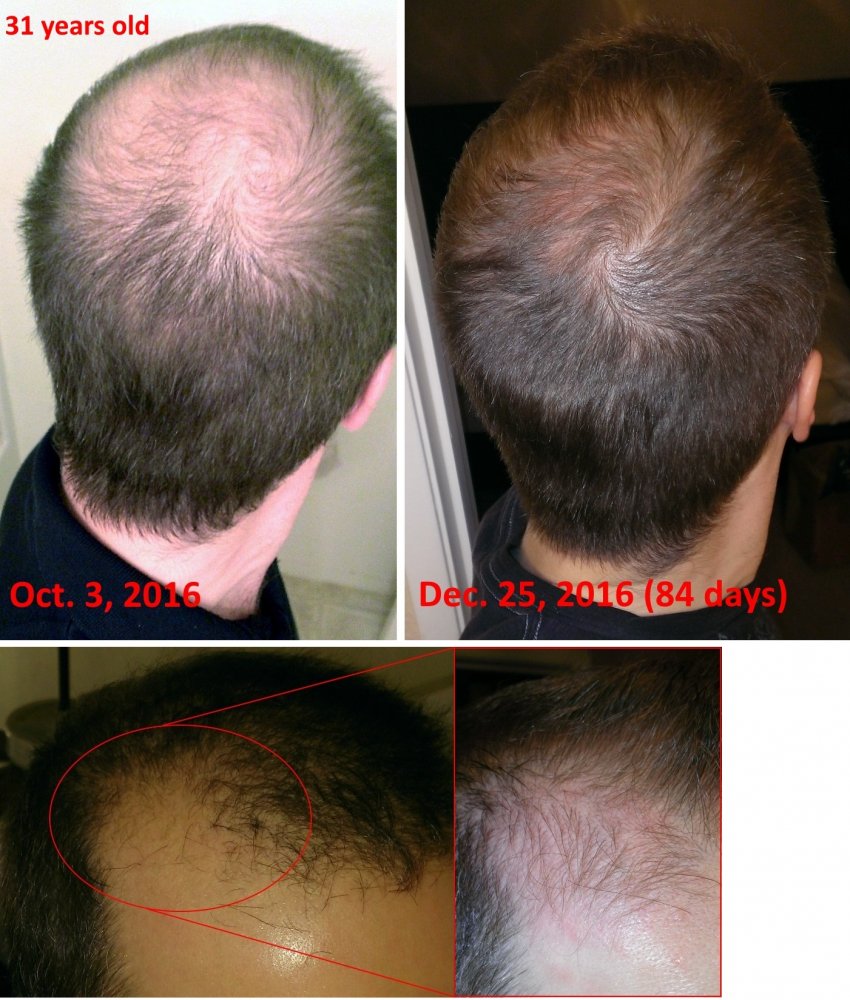 finasteride 5 months no results