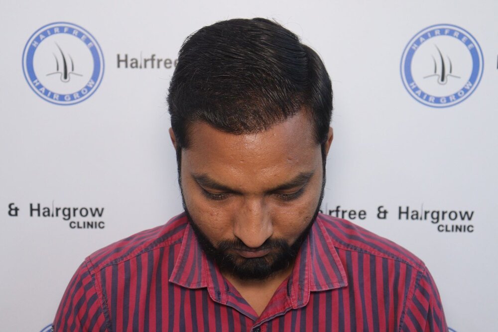 6 Month hair transplant result.jpg