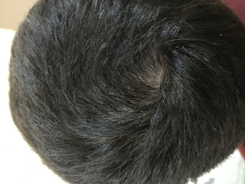 M/22 Is This A Cowlick Or A Sign I Am Receding At The Crown? | HairLossTalk  Forums