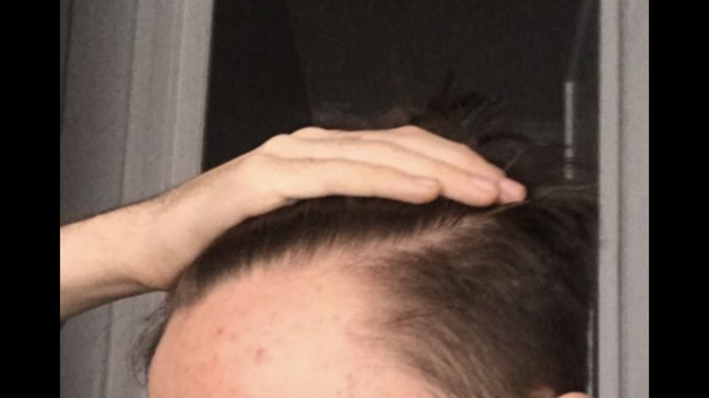 15 Years Old With Thinning On Right Side? | HairLossTalk Forums