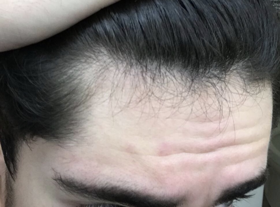 [update] Anyone See A Concerning Pattern In My Hairline