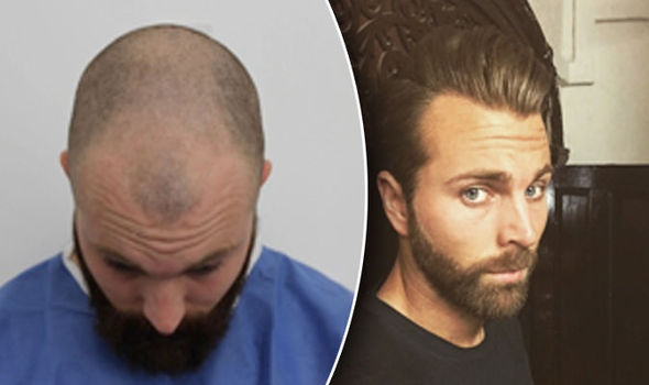 A-hair-transplant-helped-barber-with-new-start-733102.jpg