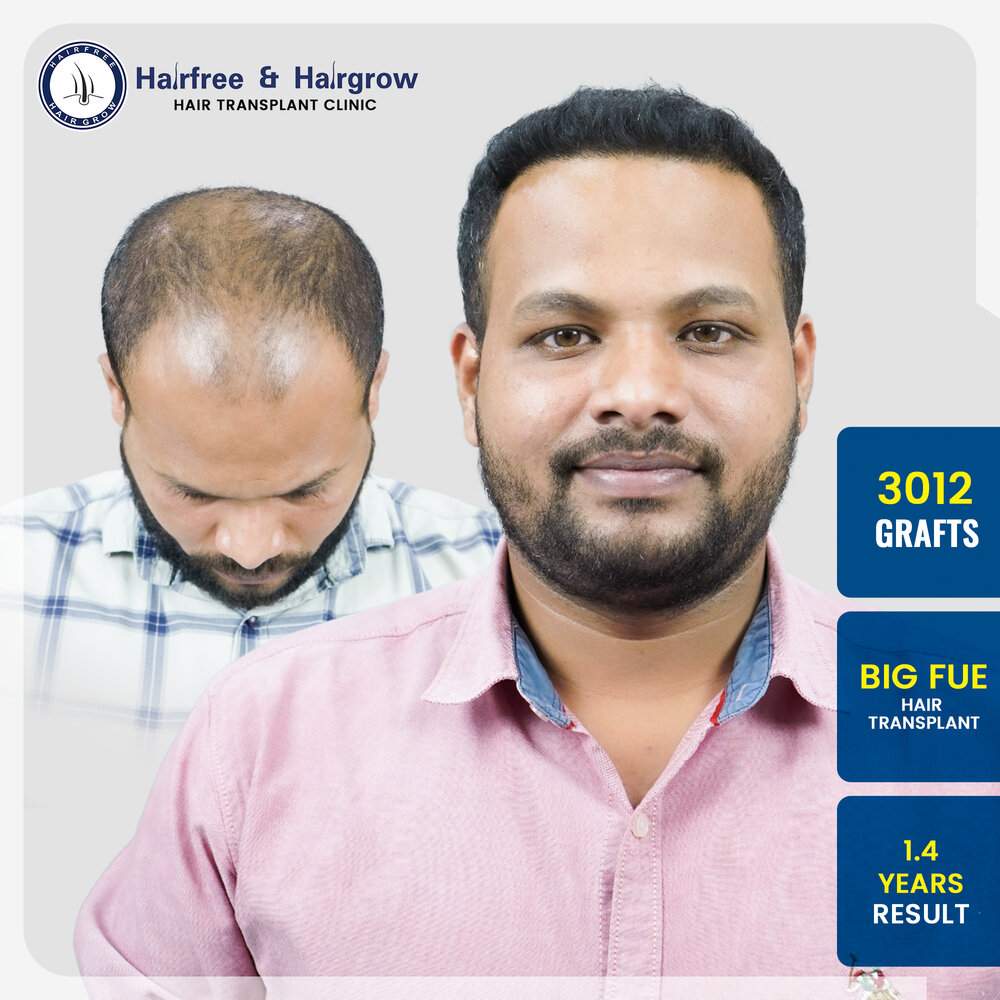abhishek-rajamne-hair-transplant-result-pune-india-3012-grafts-big-fue-14-months.jpg.jpg