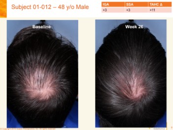 Aclaris-JAK-Inhibitor-Before-After-Male.jpg