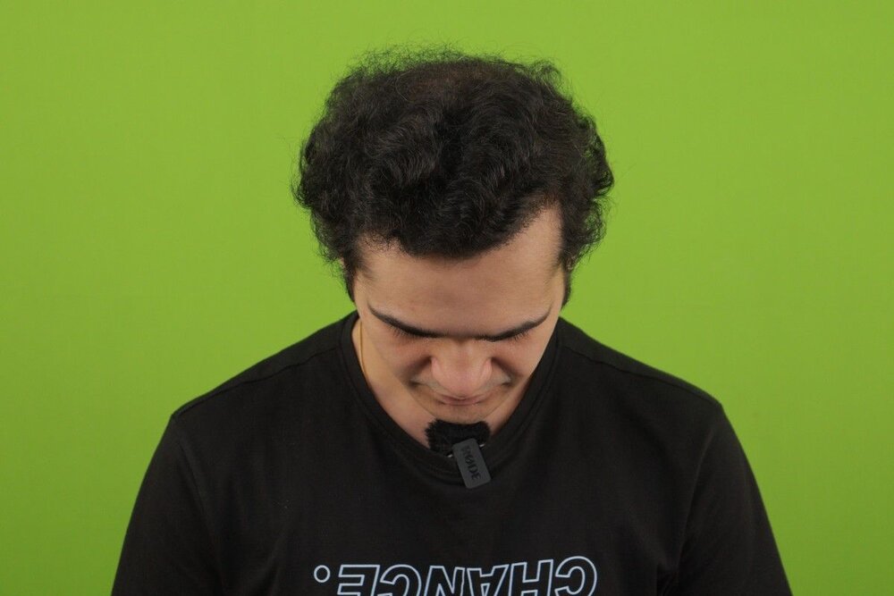 after 1 year Susmit Gogate hair transplant.JPG