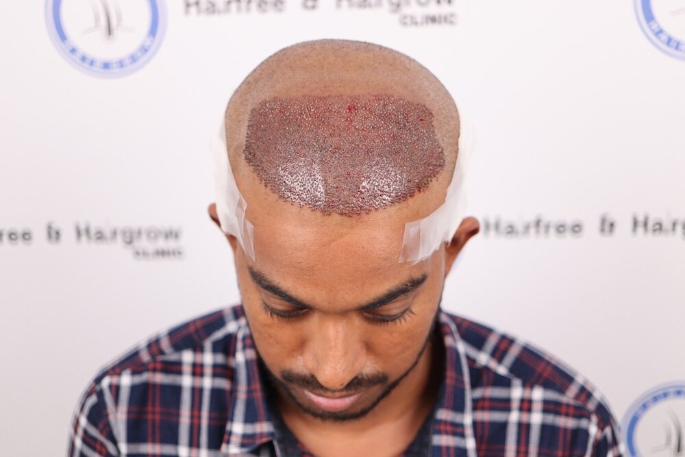 after hair transplant immediate photo.JPG