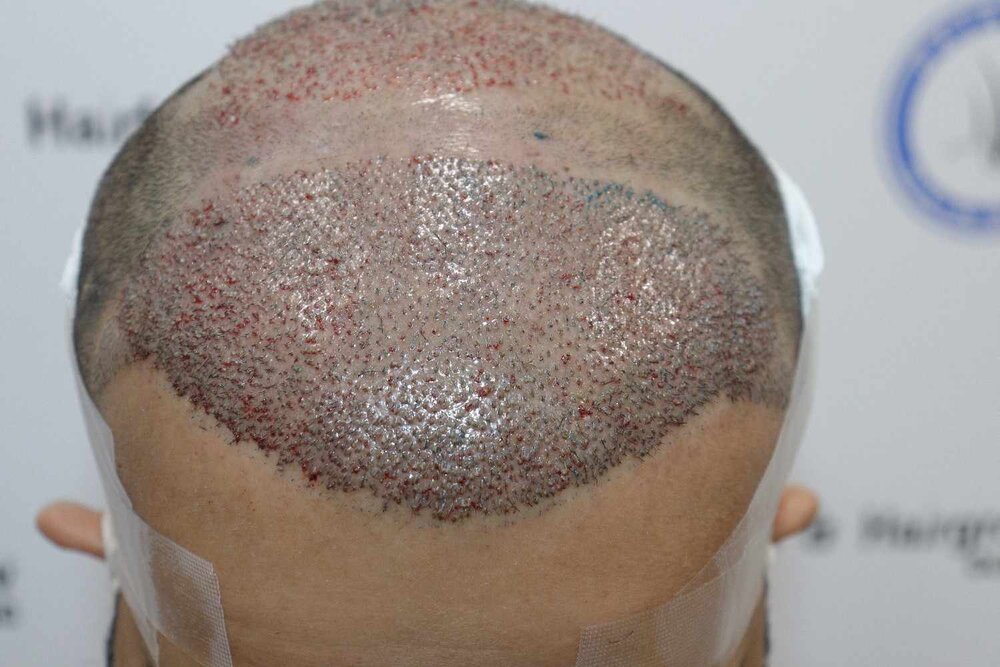 after immediate transplant pic.JPG