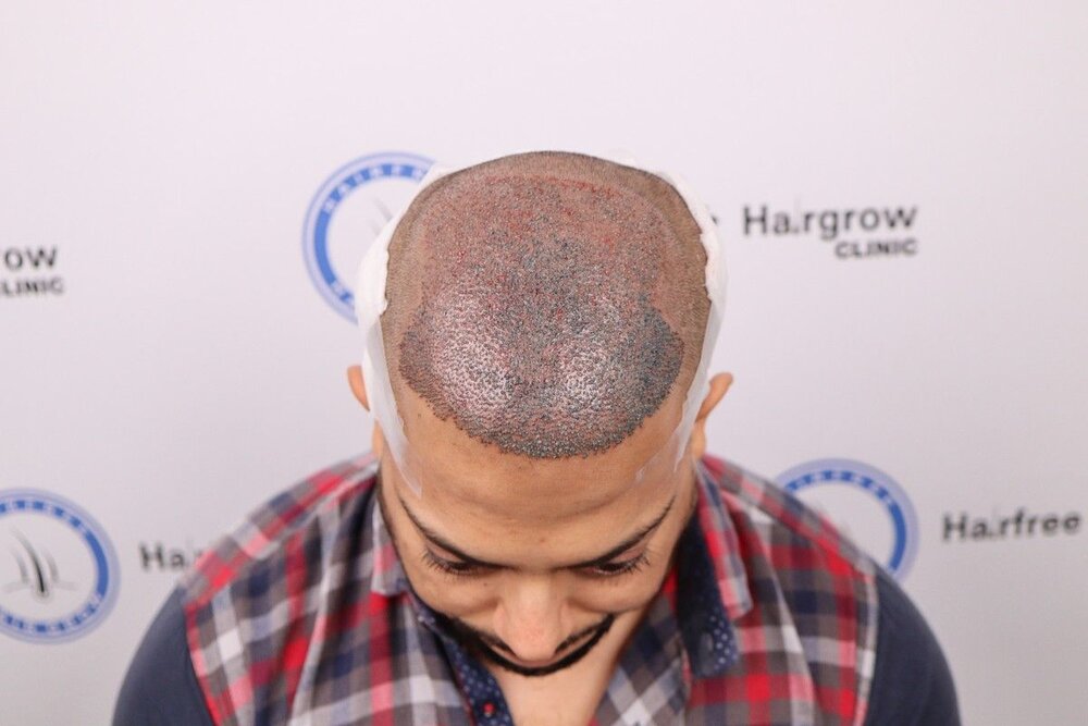 after transplant.JPG