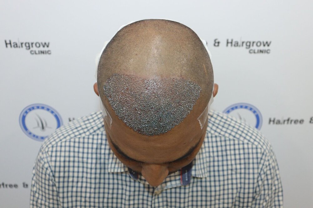 after transplant.JPG