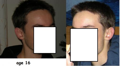 Opinion Of Hair Loss Wanted Norwood Level Comparison To 2 Years Ago Treatment Etc Hairlosstalk Forums