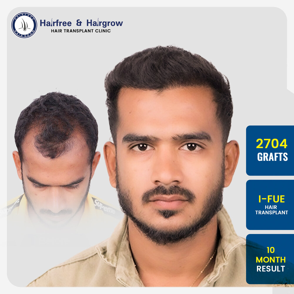 arbaz-khokar-hair-transplant-result-india-2704-grafts-i-fue-10-month.jpg.jpg