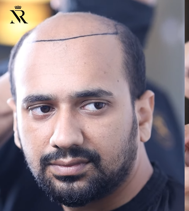 bald alrady.png