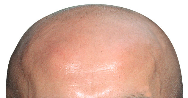 Bald-Head1.jpg