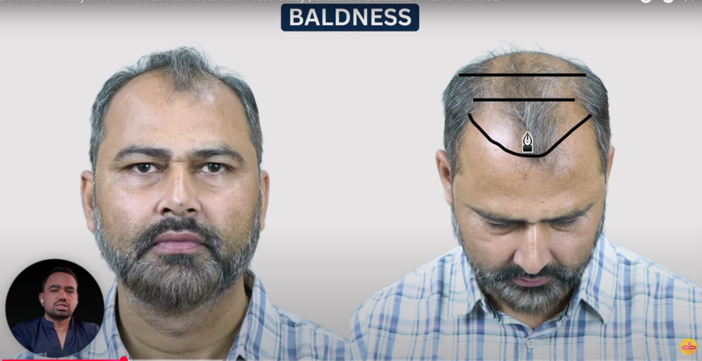 baldness.png