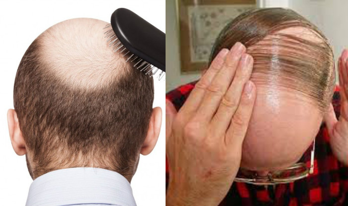 Baldness1.jpg