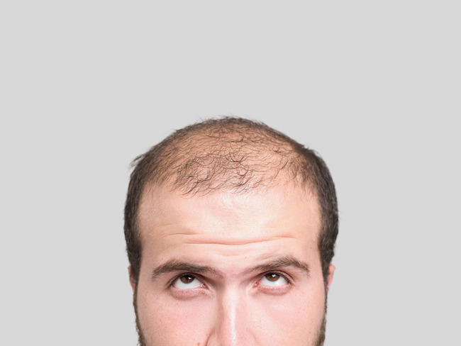 baldness_istock.jpg
